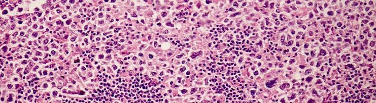 Lymphome riche en histiocytes