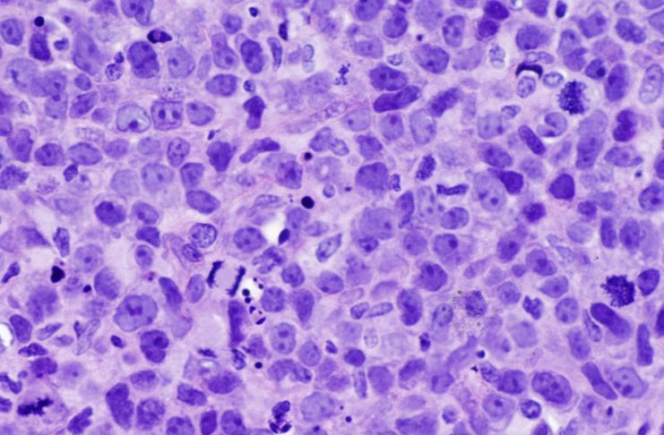 Linfoma anaplásico de células grandes