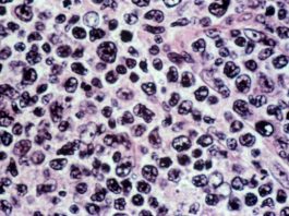 Linfoma diffuso a grandi cellule B.