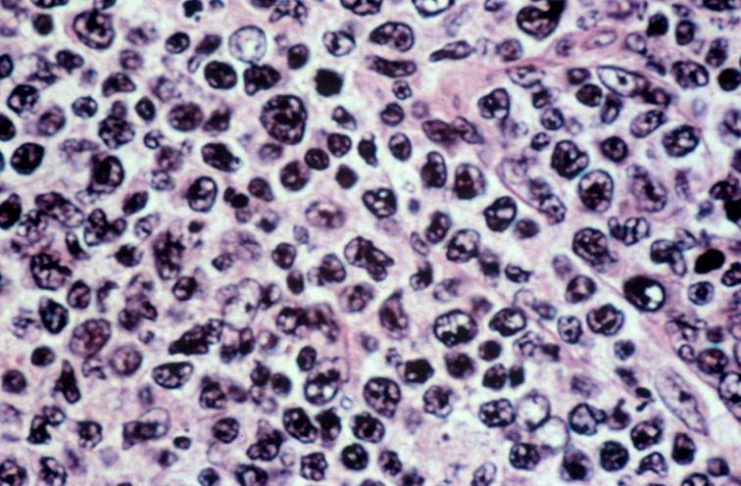 Linfoma diffuso a grandi cellule B.