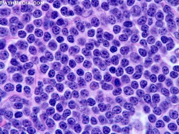 Lymphome lymphocytaire à petites cellules