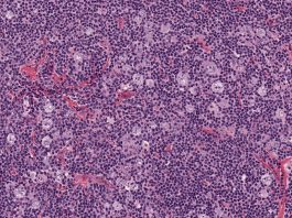 Linfoma nodulare dominante linfocita