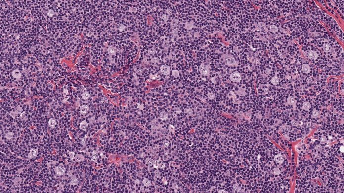 Linfoma nodulare dominante linfocita