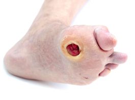 Infección del pie diabético