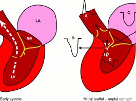 Miocardiopatía hipertrófica