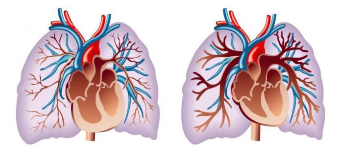 Ağciyər hipertenziyası