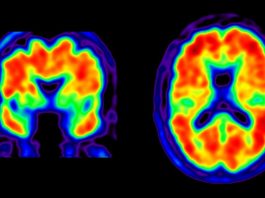 Alzheimer e PET scan