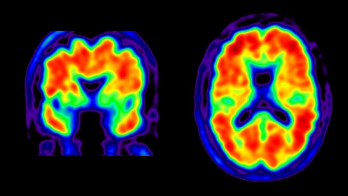 Alzheimer e PET scan