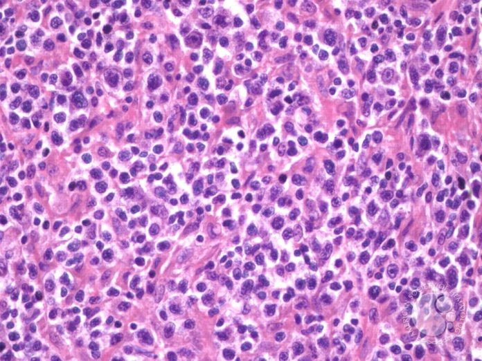 Linfoma Periférico De Células T