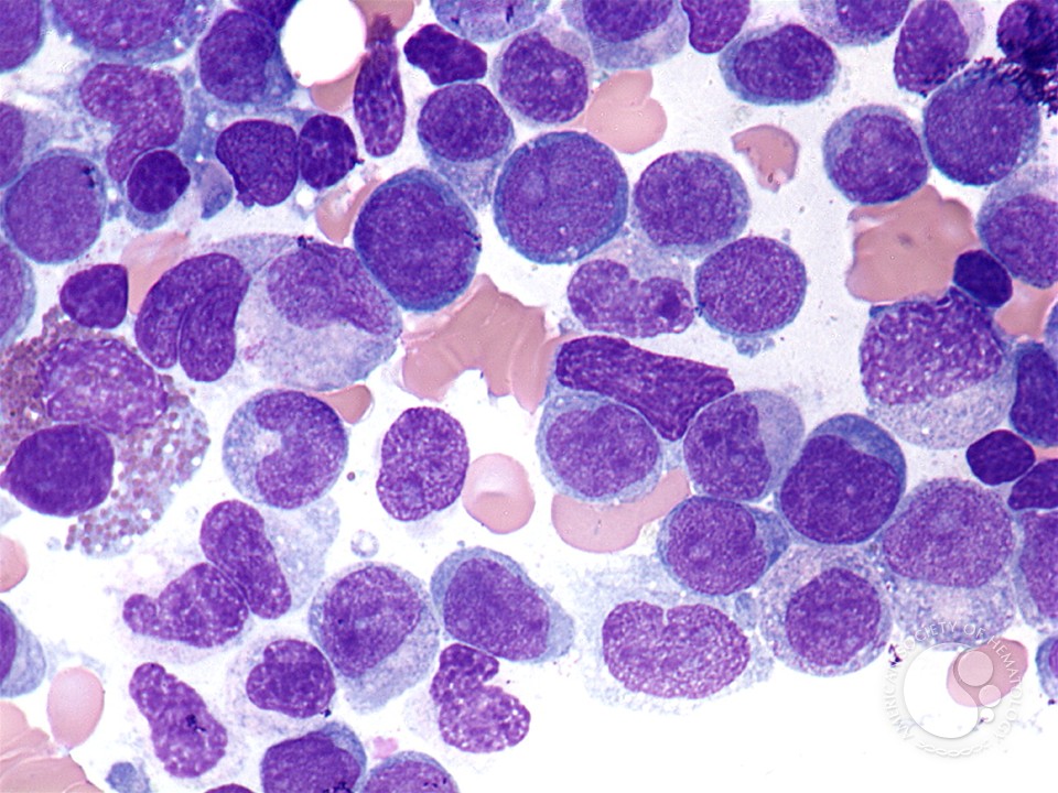 Leucemia Mielomonocítica Aguda
