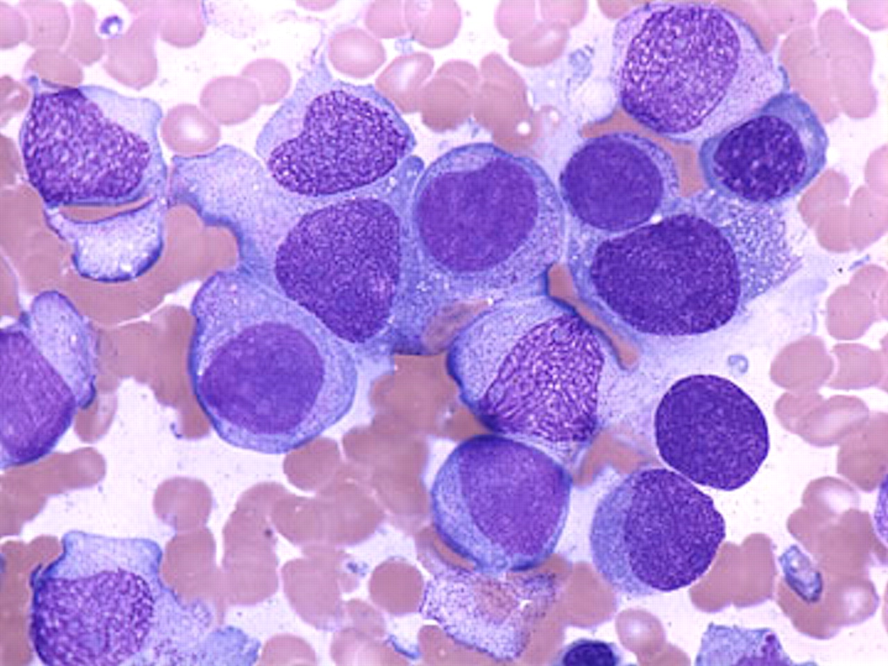 Leucémie Monocytaire Aiguë (LMA-M5)