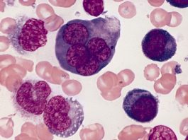 Leucemia Eritroide Aguda