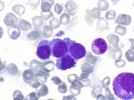 Leucemia Megacarioblastica Acuta