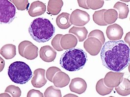 Leucémie Polymphocytaire à Cellules T