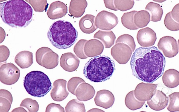 Leucemia Prolinfocitica A Cellule T
