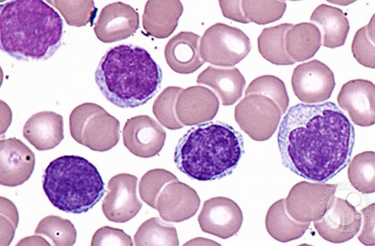 Leucemia Prolinfocitica A Cellule T