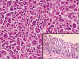 Linfoma de células T tipo enteropatía