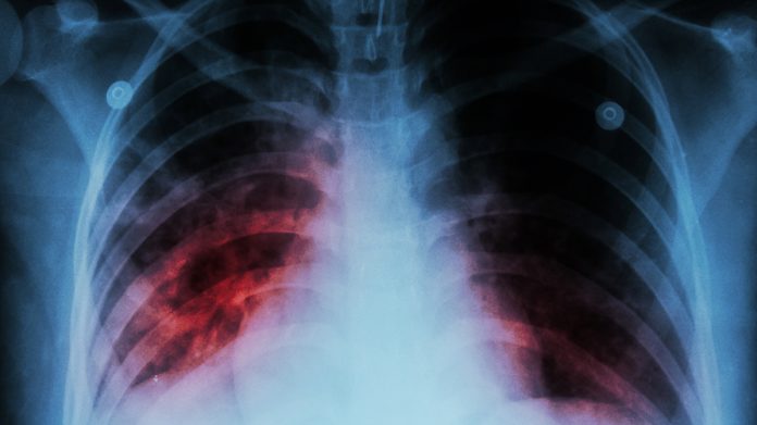 Medicamentos Contra La Tuberculosis