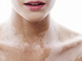 Qu'est-ce que le vitiligo?