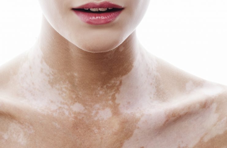 ¿Qué es el vitiligo?
