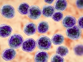 Avances en el tratamiento del linfoma de células del manto